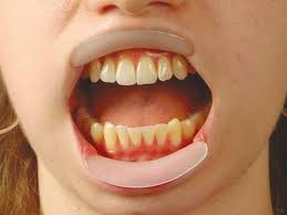 Spandex vertical lippenexpander